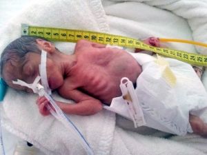 590 Gram Doğan Parmak Bebek 2400 Grama Ulaşınca Taburcu Edildi
