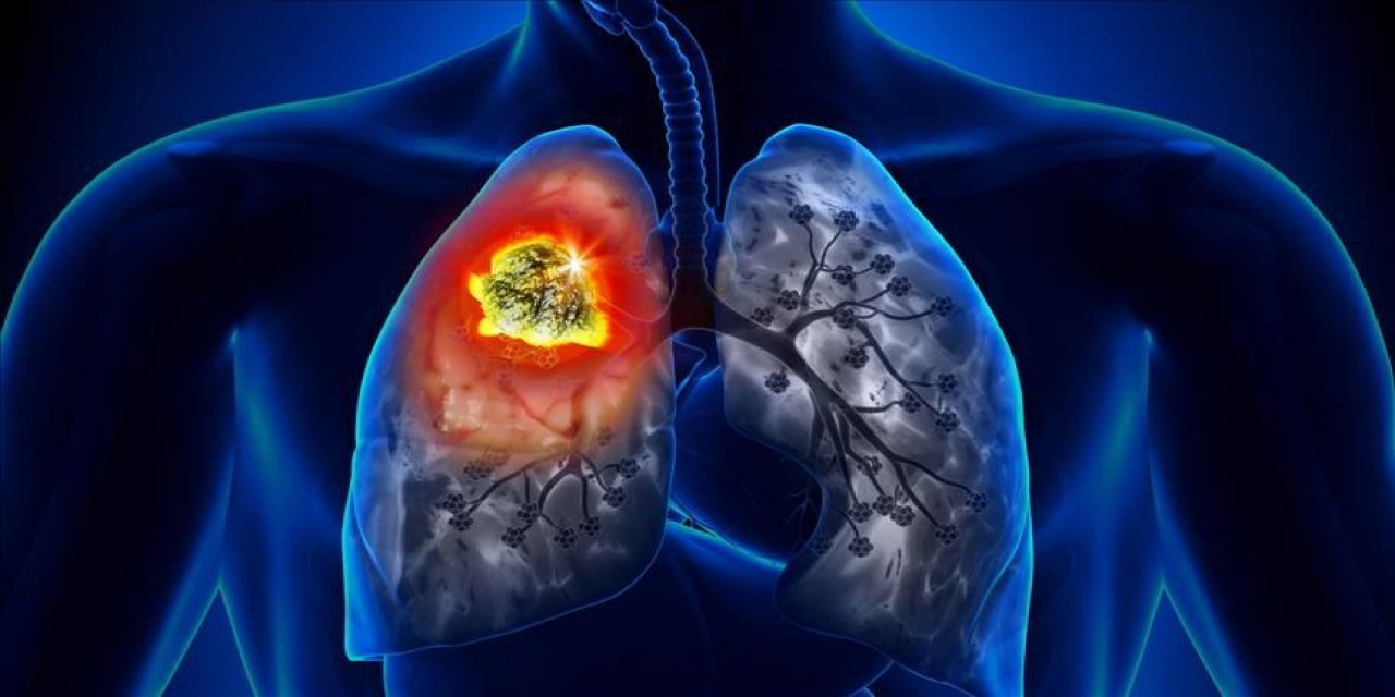 Uzmanlardan kritik uyarı! Akciğer kanserini artıran 6 risk