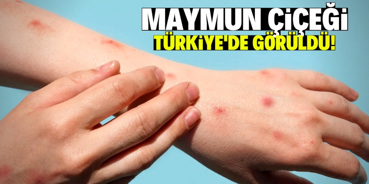 Türkiye'de maymun çiçeği tespit edildi