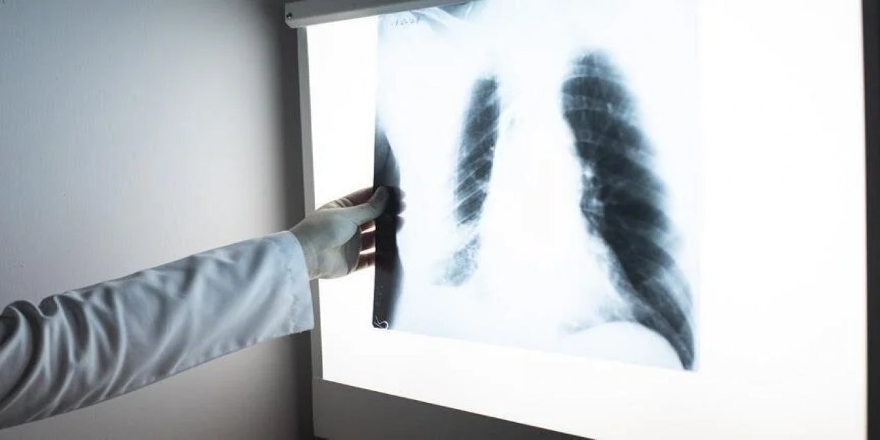 Erkekler en çok "akciğer" kadınlara  "akciğer kanseri" görülüyor