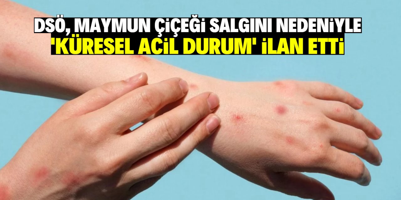 DSÖ, maymun çiçeği salgını nedeniyle  'küresel acil durum' ilan etti