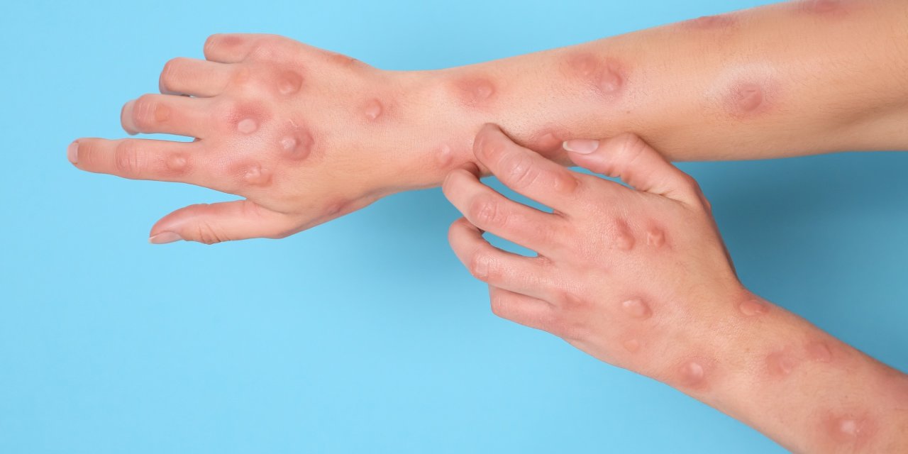 M çiçeği virüsüne karşı hedefli aşılama