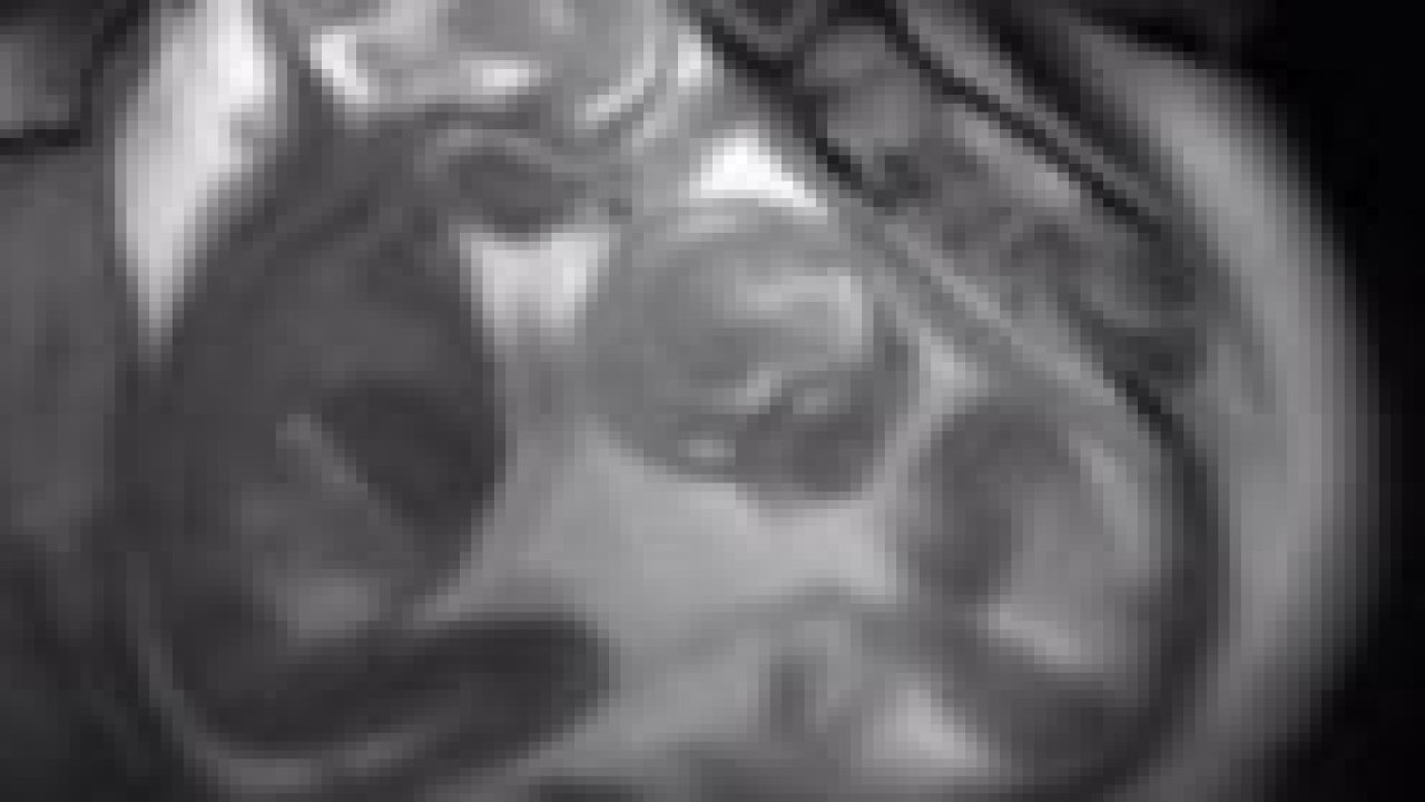 Bu bir ilk! Anne karnında kavga