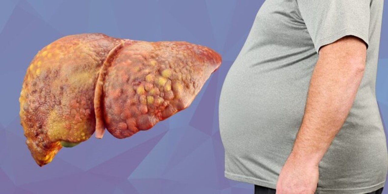 Karaciğer yağlanması sirozu tetikliyor