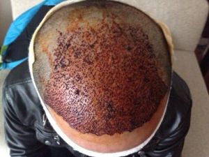 Uzmanlardan Saç Ekiminde ‘merdiven Altı’ Uyarısı