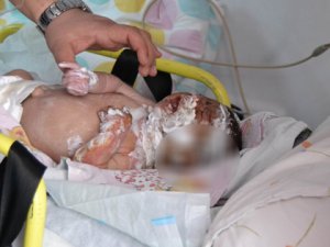 Suriyelilerin çadırında yangın çıktı: 1 bebek ağır yaralı