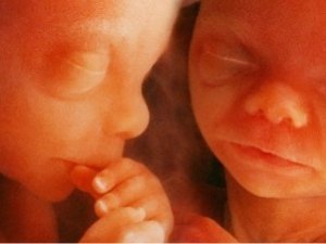 Anne karnındaki 165 ve 180 gramlık ikizlere kan nakli