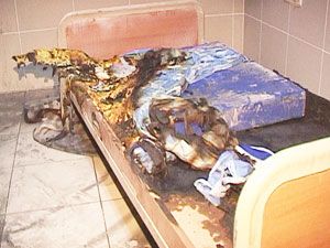 Hasta yatağını ateşe verdi