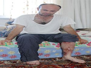 Trafik kazası yatağa mahkum etti
