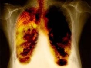 İleri evre akciğer kanseri hastalarına umut ışığı