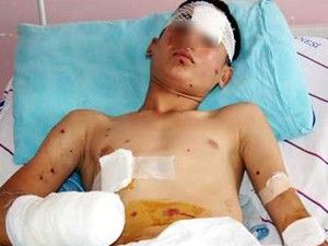 Polise atacağı bomba patladı, eli koptu