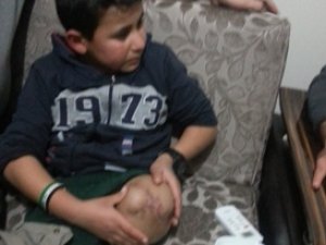 Bacağını Suriye'de bıraktı