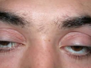 Göz kapağı şekil bozukluğu körlük nedeni olabilir